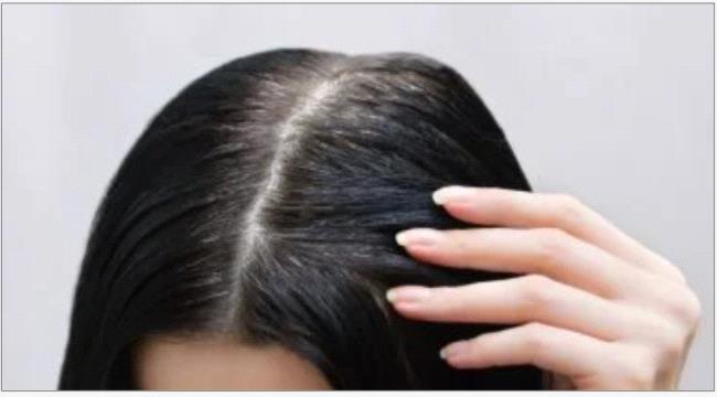5 علامات لتلف الشعر تدل على مشكلات فى الكبد والكلى