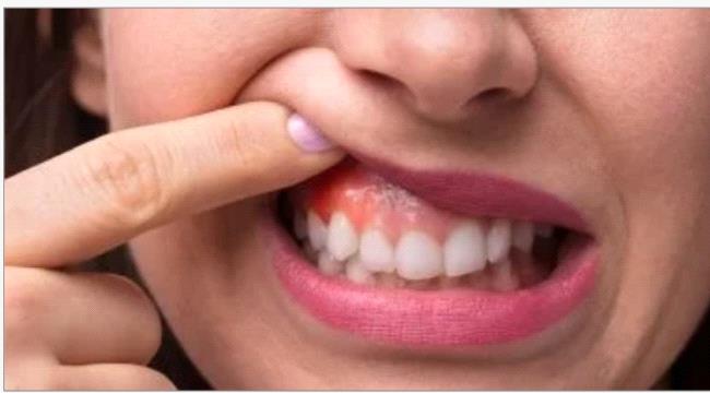 10 عادات يومية تضر بصحة أسنانك ولثتك.. توقف عنها
