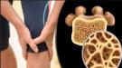 FDA توافق على مادة فعالة جديدة لعلاج مرض عظمى نادر.