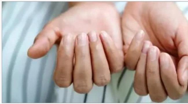 الالتهاب حول الأظافر.. ما أسبابه وكيفية العلاج