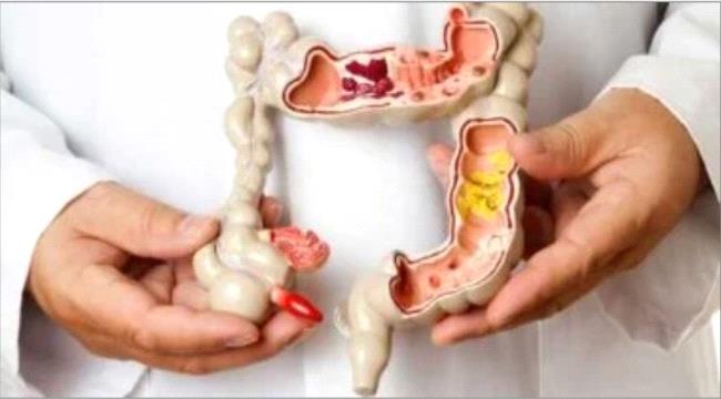 حالة مرضية بالقولون قد تسبب التهاب المفاصل .. ما هي ؟